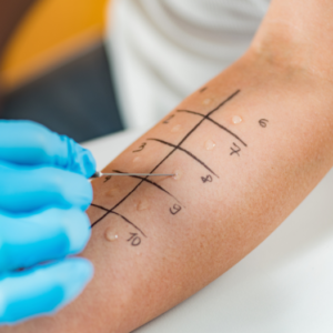 allergy testing - blood testing in London